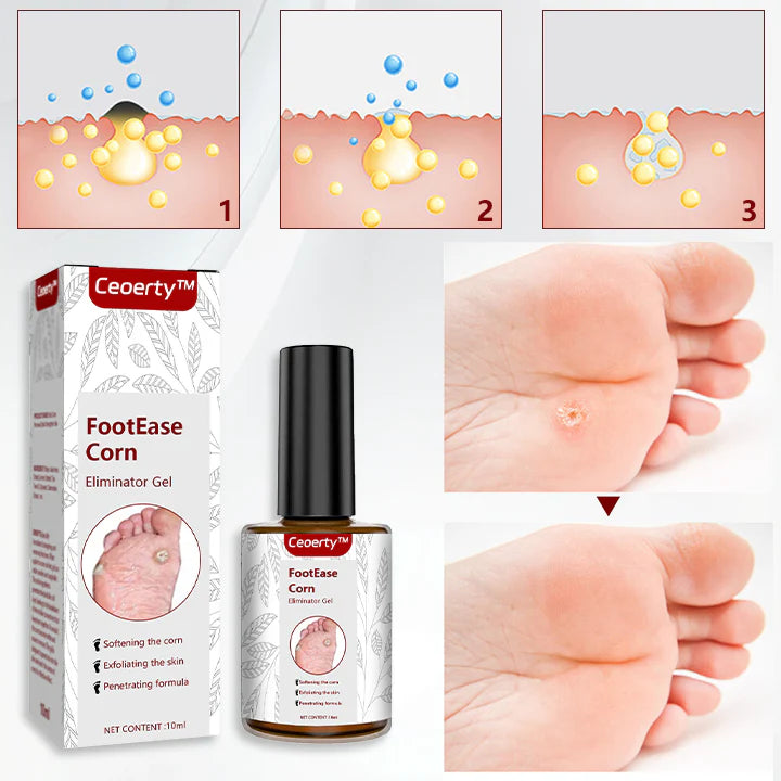 Feet Corn Removal Serum 30ml (Buy 1 Get 1 Free)