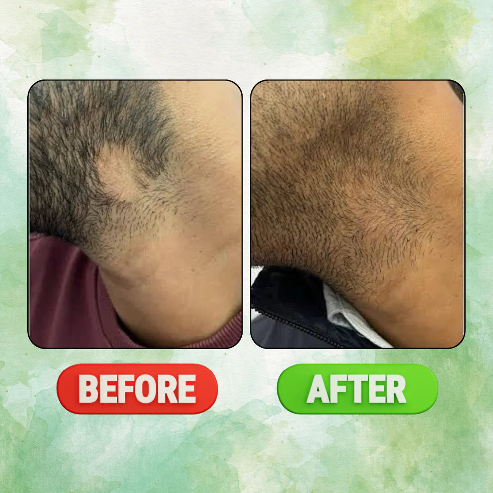 Alopecia Hair Patch Solution (45 ML ROLL-ON)