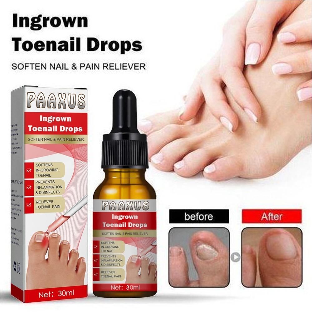 Ingrown Toenail Drops 30 ml Pack of 1