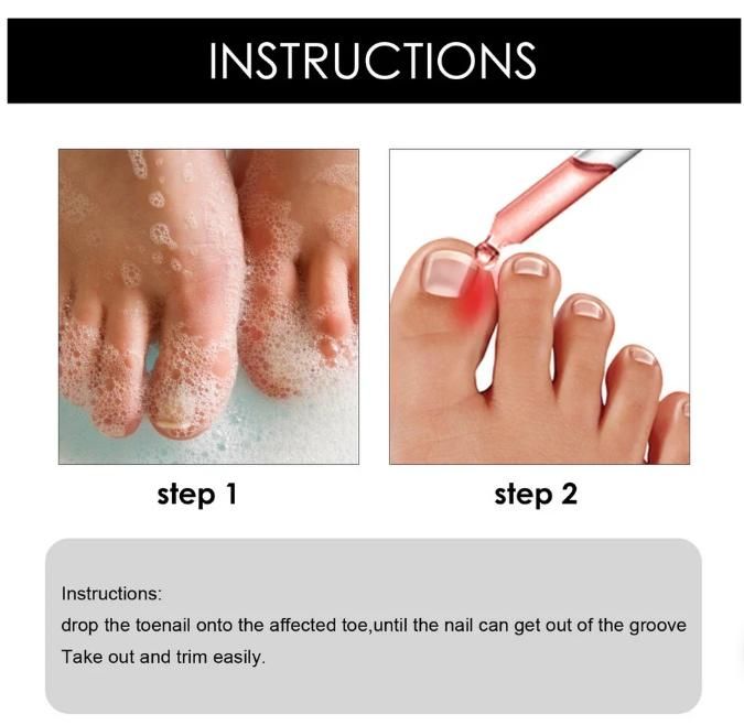 Ingrown Toenail Drops 30 ml Pack of 1
