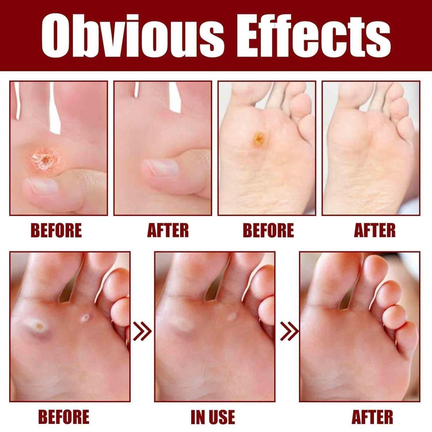 Feet Corn Removal Serum 30ml (Buy 1 Get 1 Free)