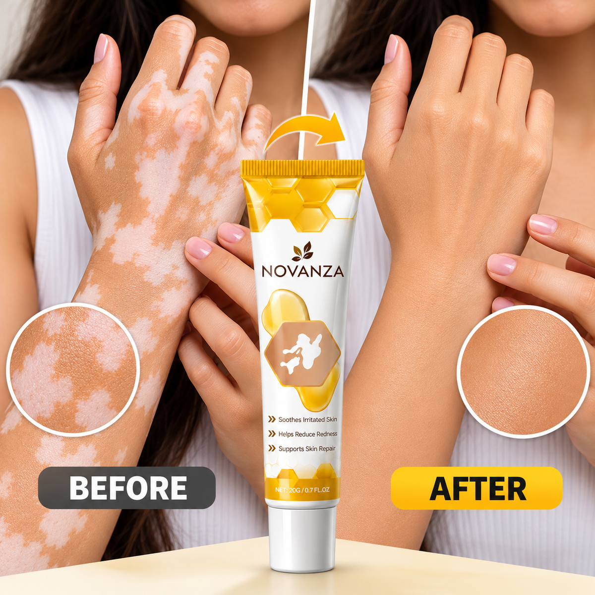 Novanza's Vitiligo Cream (Buy 1 Get 1 Free)