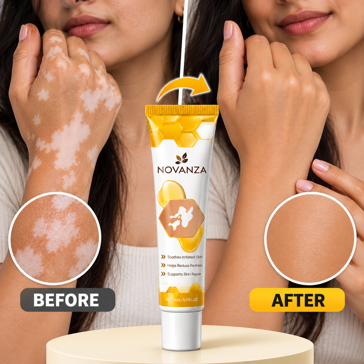 Novanza's Vitiligo Cream (Buy 1 Get 1 Free)