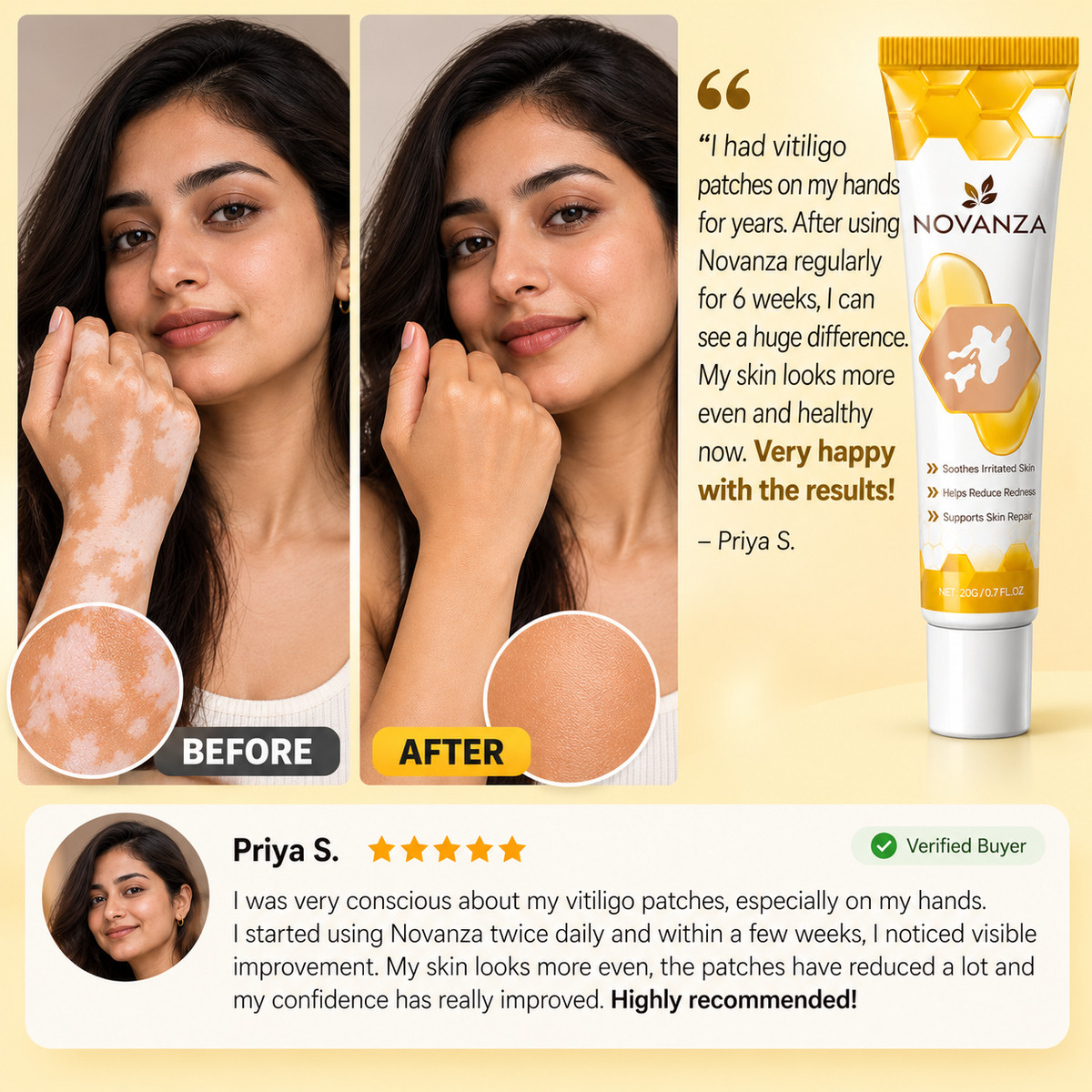 Novanza's Vitiligo Cream (Buy 1 Get 1 Free)