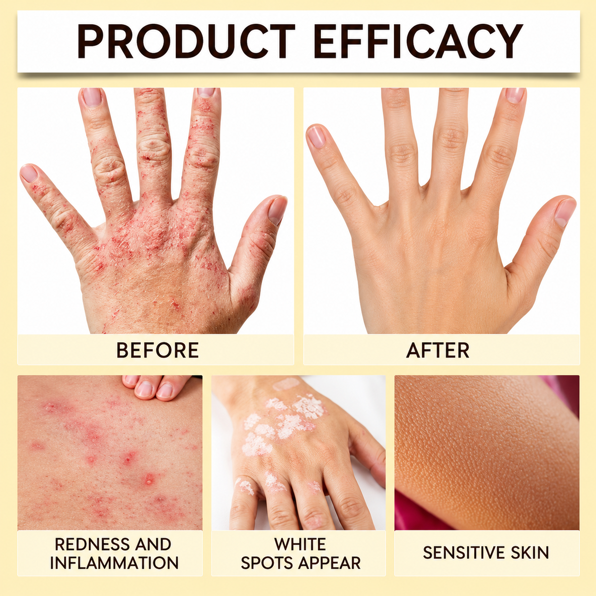Novanza's Vitiligo Cream (Buy 1 Get 1 Free)