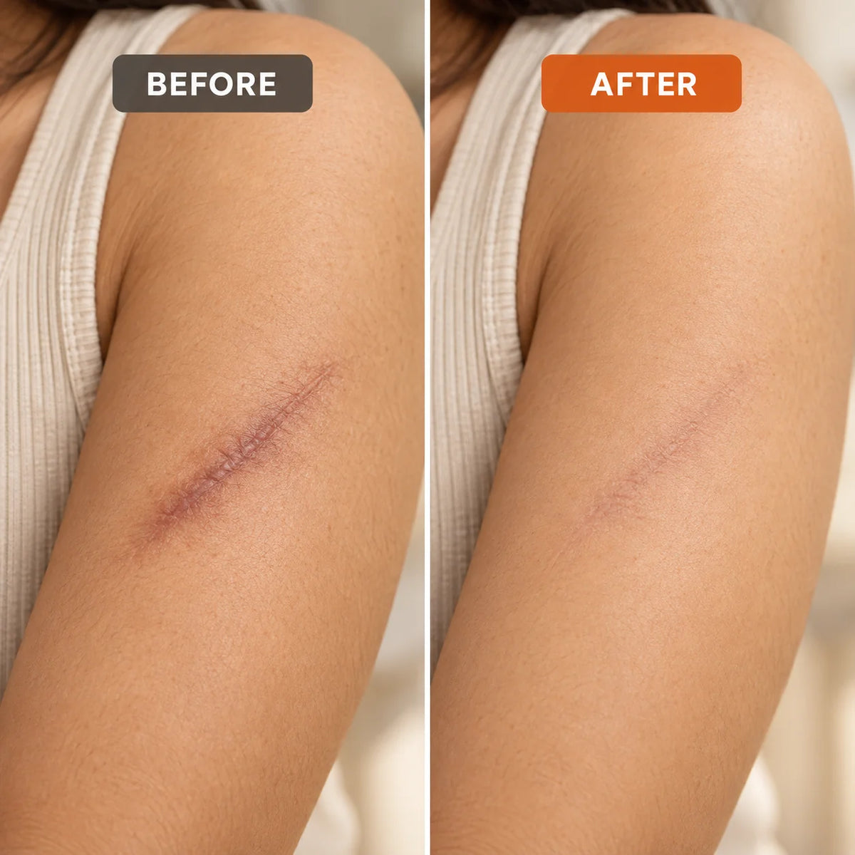 Scar Removal Cream (Buy 1 Get 1 Free)